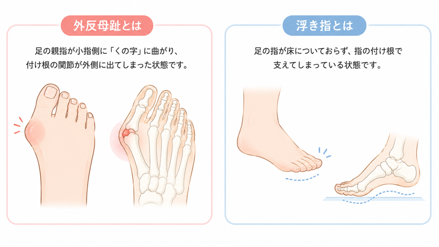 外反母趾・浮き指とは