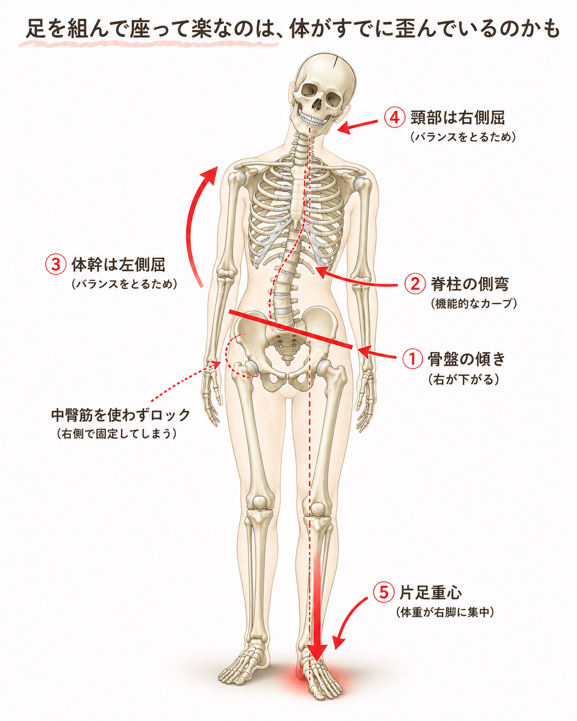 脚を組む癖から始まる体の歪みの連鎖（骨盤の傾き・脊柱側弯・体幹と頸部の側屈・片足重心）